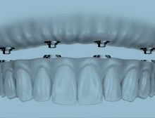 Full Arch Implant Therapy