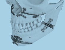 Orthognathic Surgery